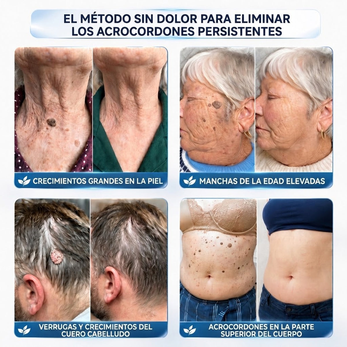 墨CureVivo® Crema para Eliminar Verrugas y Etiquetas Cutáneas en 7 Días (Fórmula Sin Dolor – Sin Cicatrices)🤗