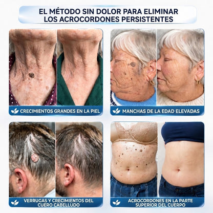 墨CureVivo® Crema para Eliminar Verrugas y Etiquetas Cutáneas en 7 Días (Fórmula Sin Dolor – Sin Cicatrices)🤗