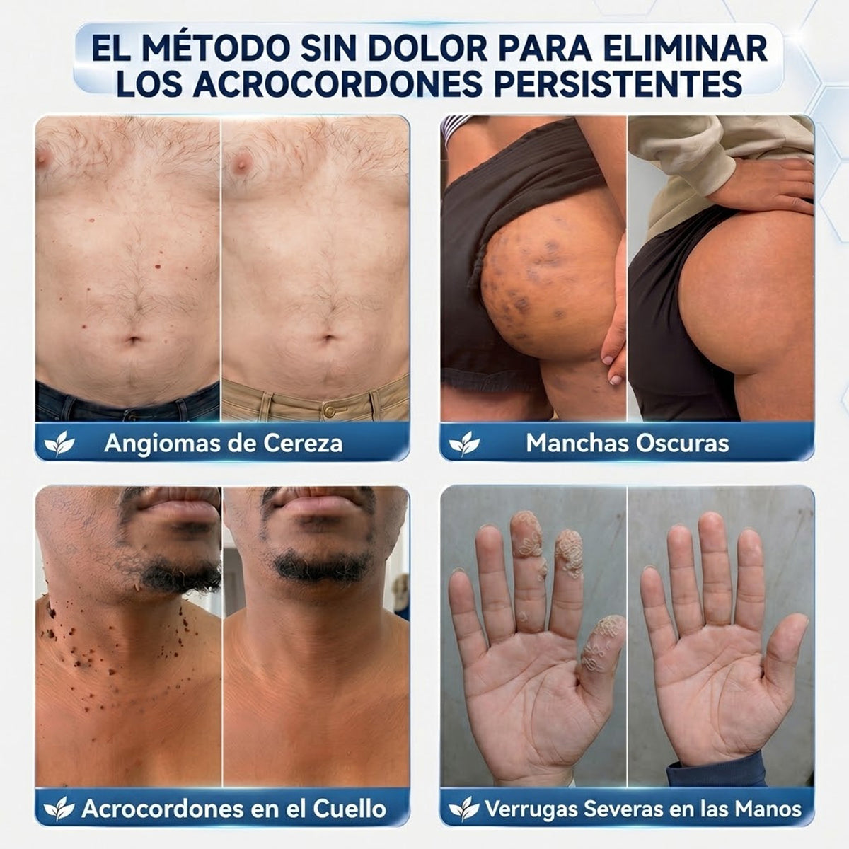 墨CureVivo® Crema para Eliminar Verrugas y Etiquetas Cutáneas en 7 Días (Fórmula Sin Dolor – Sin Cicatrices)🤗