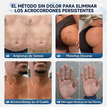 墨CureVivo® Crema para Eliminar Verrugas y Etiquetas Cutáneas en 7 Días (Fórmula Sin Dolor – Sin Cicatrices)🤗