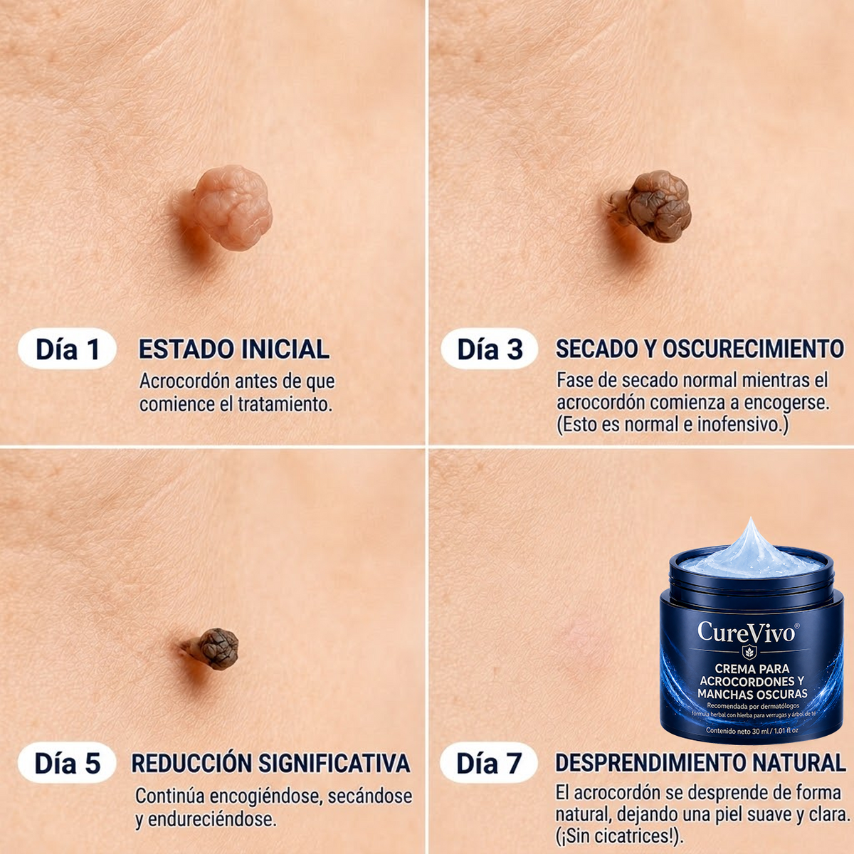 墨CureVivo® Crema para Eliminar Verrugas y Etiquetas Cutáneas en 7 Días (Fórmula Sin Dolor – Sin Cicatrices)🤗