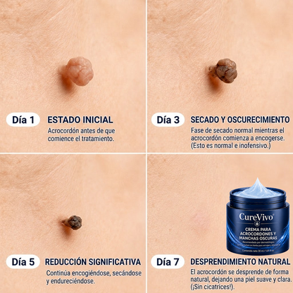 墨CureVivo® Crema para Eliminar Verrugas y Etiquetas Cutáneas en 7 Días (Fórmula Sin Dolor – Sin Cicatrices)🤗