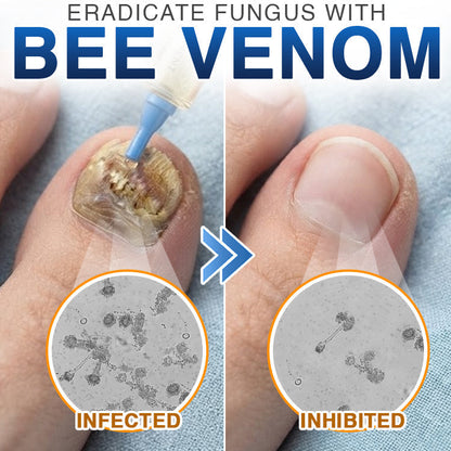 🇦🇺 CareBreeze® Fungi Free Bee Venom Nail Treatment 🐝