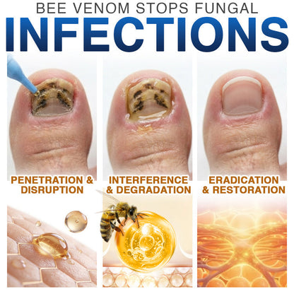 🇦🇺 CareBreeze® Fungi Free Bee Venom Nail Treatment 🐝