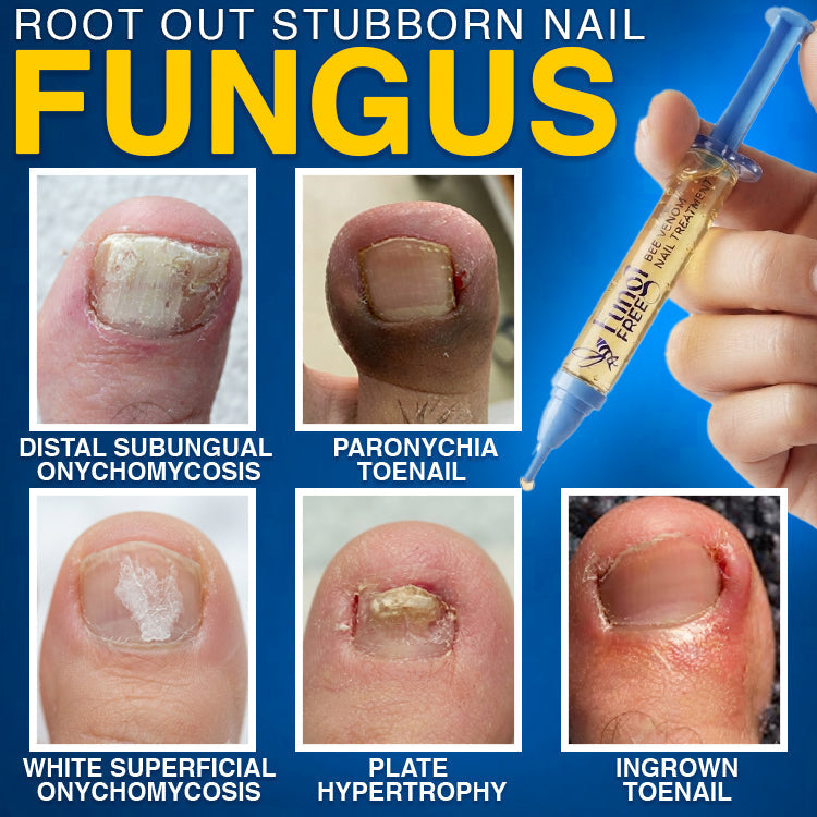 🇦🇺 CareBreeze® Fungi Free Bee Venom Nail Treatment 🐝