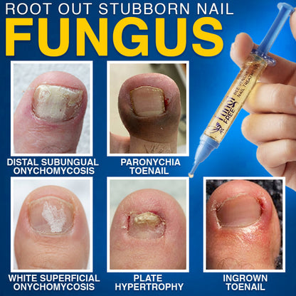 🇦🇺 CareBreeze® Fungi Free Bee Venom Nail Treatment 🐝